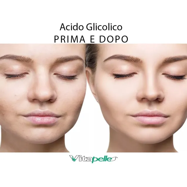 acido glicolico prima e dopo
